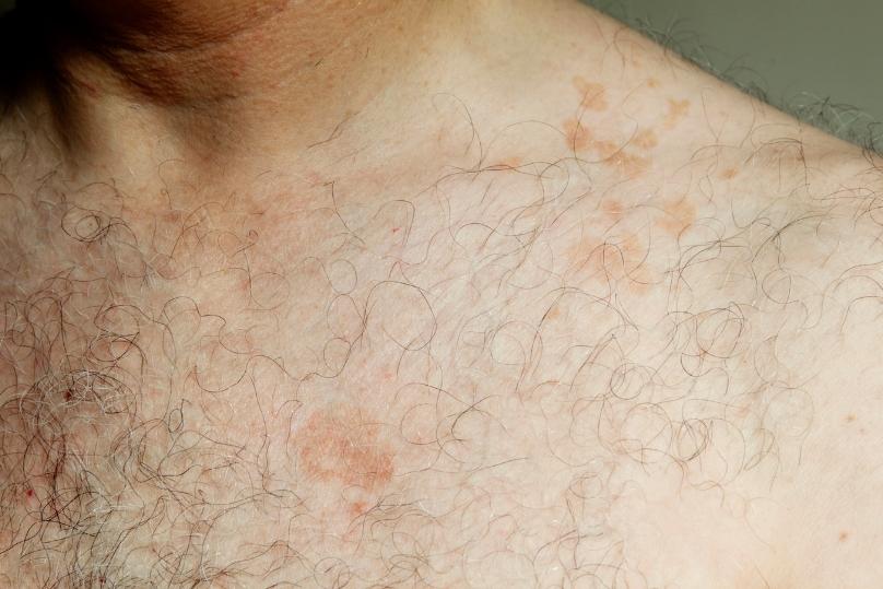 ผื่นกุหลาบ thai-herbs.thdata.co | ผื่นกุหลาบ สรรพคุณ สมุนไพร ไทย 